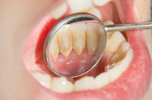 Karang Gigi Menyebabkan Bau Mulut